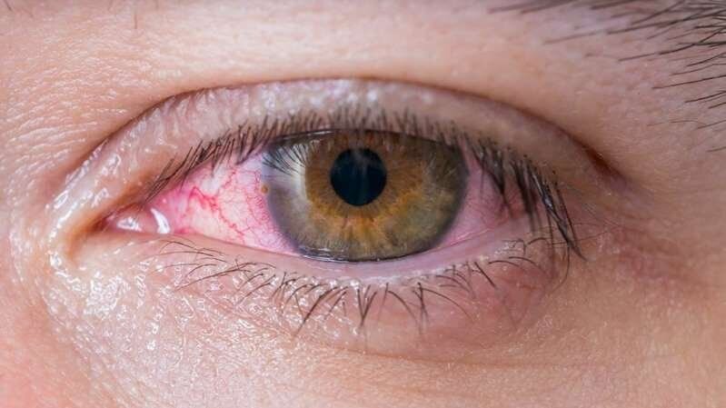 Ojo Seco: Causas, Síntomas y Soluciones Efectivas 9 ¿Qué enfermedad produce sequedad en los ojos?